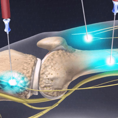 Coolief Radio Frequency Ablation in hyderabad